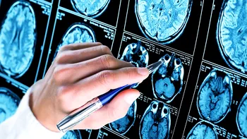 Un nou instrument de inteligență artificială detectează leziuni cerebrale ascunse la copiii cu epilepsie
