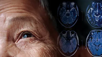 Noi descoperiri legate de tratamentul bolii Parkinson: Ce au aflat oamenii de știință, cât de simplă ar fi soluția, în opinia lor, de fapt