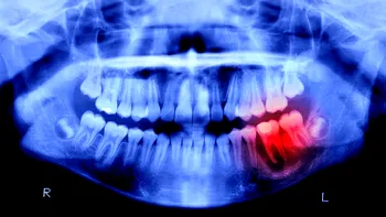 Dinții pierduți ar putea crește din nou. Tratamentul testat pe oameni care poate schimba stomatologia până în 2030