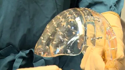Un pas mare pentru medicină: primul transplant de cutie craniană printată 3D