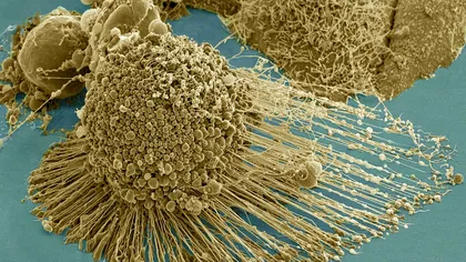 ”Înfometarea” cancerului pare cea mai sigură metodă de a-l combate
