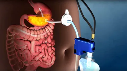 Metodă neobișnuită de slăbit: pompa care îți extrage mâncarea din stomac