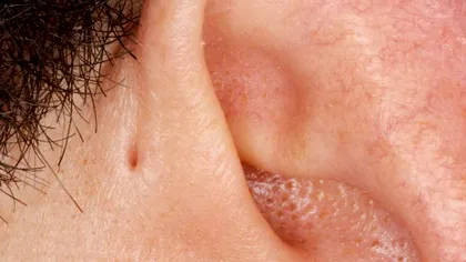 De ce unii oameni au o mică gaură în zona urechii