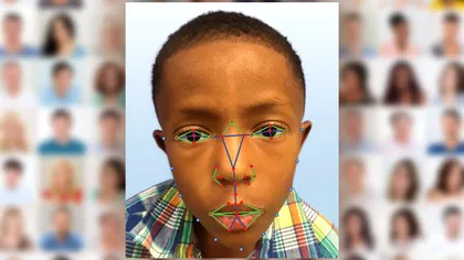 Recunoașterea facială le va permite medicilor să detecteze afecțiunile genetice rare