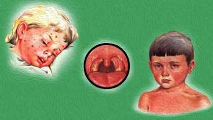 Epidemia de rujeolă din România atinge cote alarmante: de ce este importantă vaccinarea
