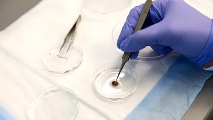 Plasturii printați 3D ar spori procesul de vindecare în urma unui atac de cord