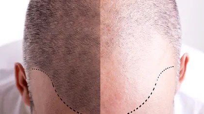 De ce părul albește sau cade odată cu înaintarea în vârstă