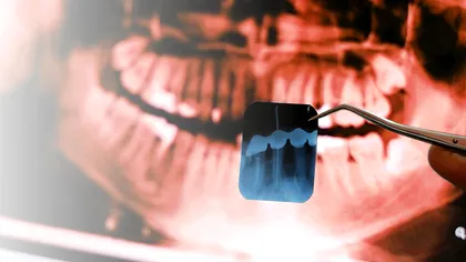 Un tratament descoperit din greșeală ți-ar putea repara dinții