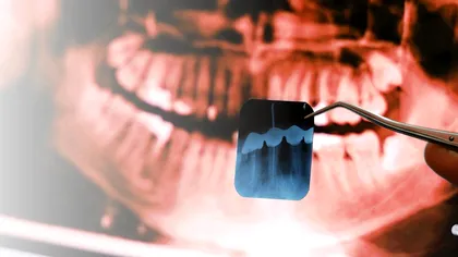 Tratamentul care vindecă dinții fără dentist sau plombe