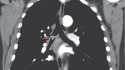 Cum a reușit un om să trăiască cinci zile cu un os de pui în plămâni