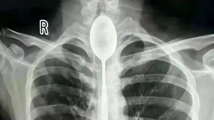 Cum a supraviețuit un bărbat cu o lingură în esofag timp de un an
