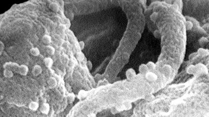 Cum a apărut virusul HIV și a distrus lumea cu boala SIDA?