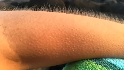 Piele de găină: de ce ți se ridică părul pe mână când asculți muzică și ce spune asta despre creierul tău