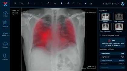 „Robotul” care analizează radiografiile pacienților din București și Timișoara ca să „vadă” dacă sunt bolnavi