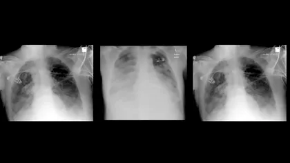 Adevăratele consecințe pe termen lung ale infecției cu coronavirus: ce se întâmplă cu plămânii