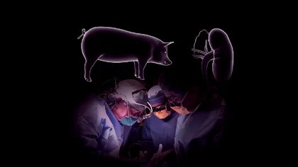 Transplanturile de organe se schimbă pentru totdeauna: premiera mondială care îți poate salva viața