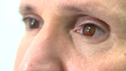 Primul bărbat din lume care va primi o proteză oculară 3D. Cum va funcționa aceasta