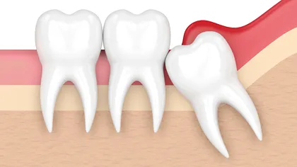 De ce apar măselele de minte atât de târziu: explicația cercetătorilor