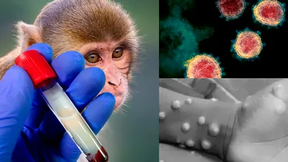 România cumpără 1000 de doze de vaccin împotriva variolei maimuței. Anunțul făcut de ministrul Sănătății