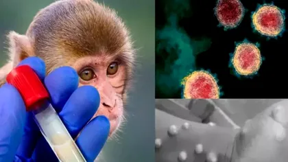 Primul copil diagnosticat cu variola maimuței. Nu are nici 10 ani