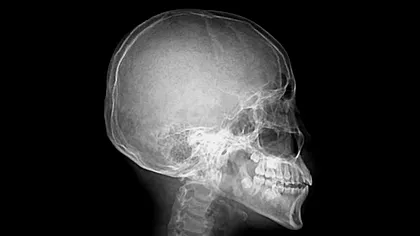 Un utilizator TikTok a descoperit la dentist că oasele lui s-au înnegrit: ce medicament a dus la asta