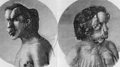 Povestea surprinzătoare, tristă și adevărată a „omului elefant”: ce afecțiuni l-au deformat