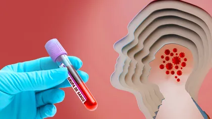 Grupa de sânge poate să determine un atac cerebral precoce, arată ultimele cercetări științifice