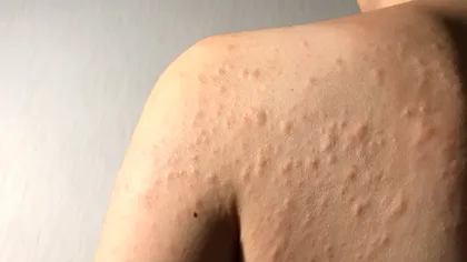 Cazul bizar al femeii cu alergie la aproape orice. Cum și-a descoperit condiția