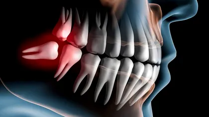 De ce ne cresc măsele de minte, ce rol au acestea, de fapt și de ce le scoatem