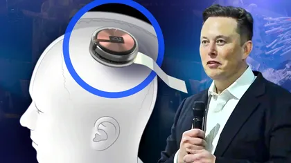 Elon Musk a dat lovitura cu Neuralink: Implantul pe creier, la om, a devenit realitate
