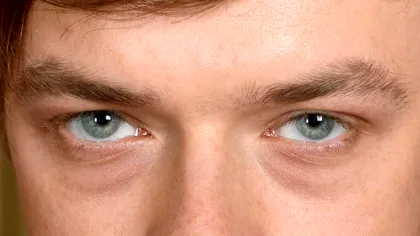 De ce facem cearcăne și 