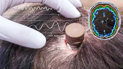 Neuralink implantează cu succes un cip în creierul celui de-al doilea pacient