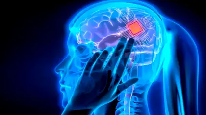 Implant cerebral revoluționar testat: O soluție bazată pe ultrasunete pentru depresie, anxietate și epilepsie