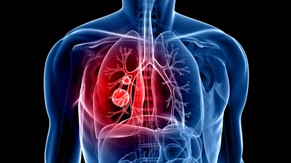 Cazurile de cancer pulmonar la nefumători sunt în creștere. Poluarea, un factor determinant