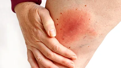 Ce este boala Lyme și cum se transmite: infecția misterioasă cu simptome înșelătoare