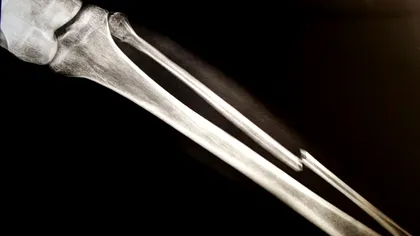 Adezivul pentru oase care le lipește în câteva minute este revoluția în medicină