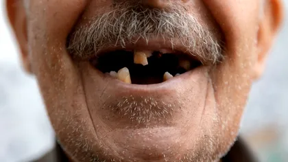 Pierderea rapidă a dinților la vârste înaintate poate semnala un risc crescut de deces, arată un studiu