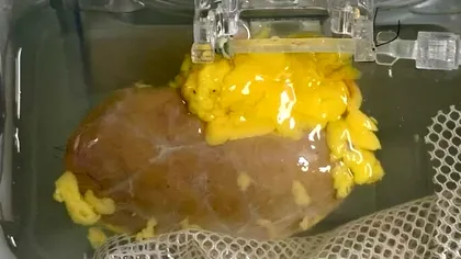 Oamenii de știință au creat „rinichiul universal” compatibil cu orice grupă de sânge. Ce înseamnă asta pentru medicină?