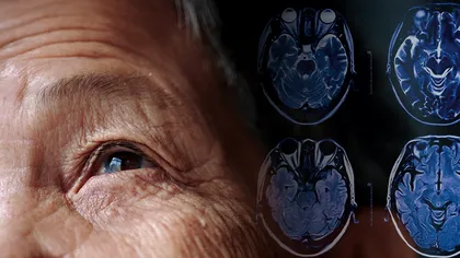 Noi descoperiri legate de tratamentul bolii Parkinson: Ce au aflat oamenii de știință, cât de simplă ar fi soluția, în opinia lor, de fapt