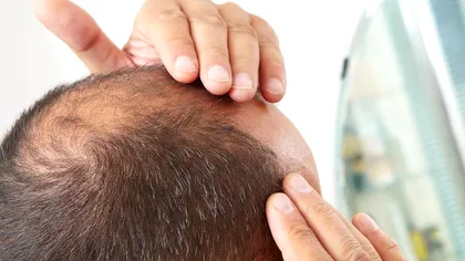 Un nou medicament împotriva chelirii, cu creștere a părului de 539% în teste. Prima noutate majoră după 30 de ani