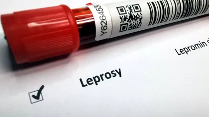 Una dintre femeile diagnosticate cu lepră la Cluj-Napoca ar fi contractat boala într-o destinație turistică populară. Unde s-ar fi infectat