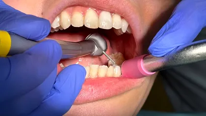 Cercetătorii promit un viitor cu freze dentare mai silențioase