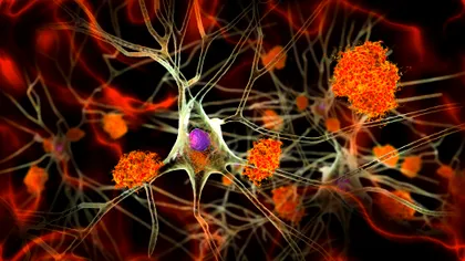 O mutație genetică extrem de rară distruge celulele creierului. Cercetătorii au aflat, în sfârșit, mecanismul