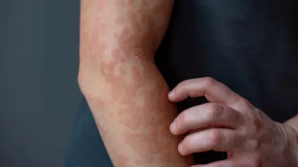 Keratina, noua piesă-cheie în lupta cu eczema și psoriazisul: studiul care schimbă felul în care privim inflamația pielii