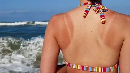 Arsurile solare, cauze și remedii. Cum să te protejezi, dacă stai la soare sau ești la mare