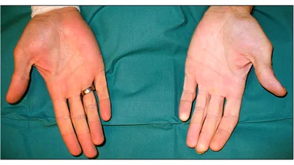 Boala focului sfânt. Ce înseamnă, de fapt, și care sunt simptomele