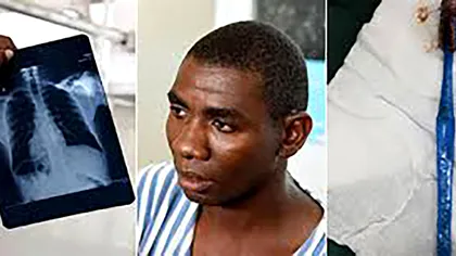 A ajuns de urgență la spital după ce s-a spălat pe dinții. Medicii au fost uimiți să vadă ce înghițise bărbatul