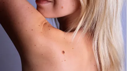 Alunițe care apar peste noapte - ce trebuie neapărat să știi despre ele