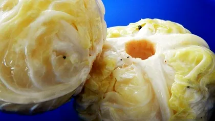 Cea mai simplă dietă cu varză murată. Cum slăbești în timp record