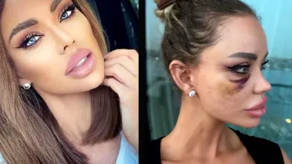 Adevărul despre pozele în care Bianca Drăgușanu e bătută: ”Vreau să înfunde puşcăria”